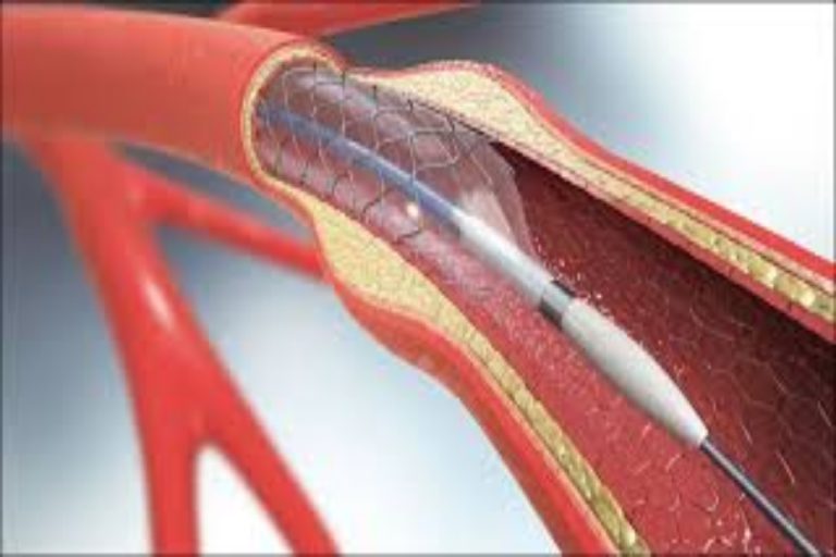 PIC under fire for implanting expired heart stents