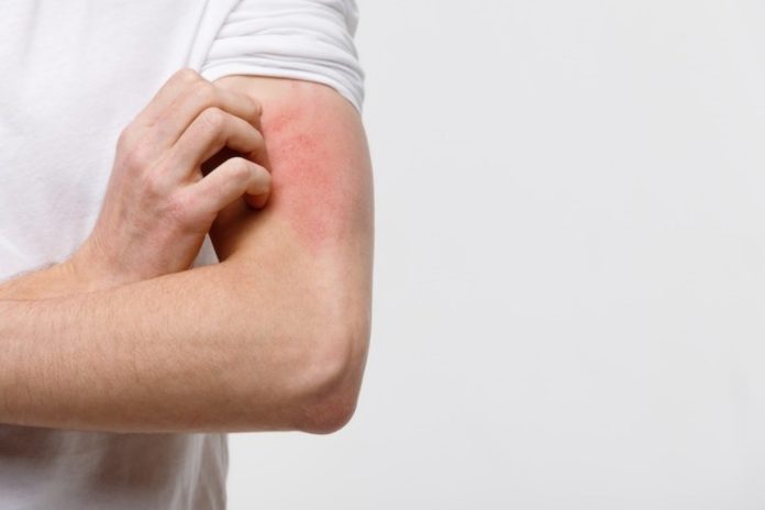 Skin Infections on rise in South Punjab amid heatwave
