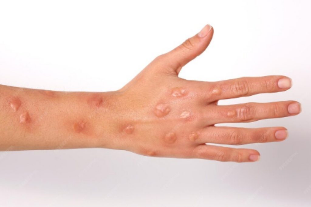 Monkeypox cases continue to increase in Lahore